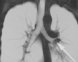 Melanoma Invades Left Mainstem Bronchus - CTisus CT Scan