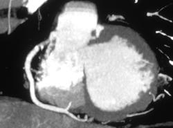 3D of Coronary Arteries - CTisus CT Scan