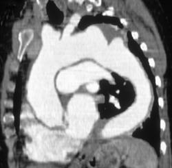 Ulcer in Aortic Arch - CTisus CT Scan