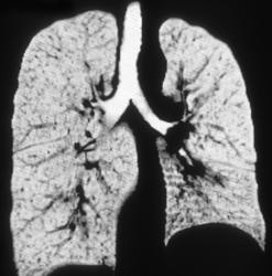 Melanoma Metastatic to Left Hilum - CTisus CT Scan