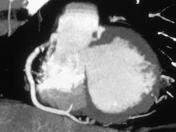 Ct Coronary Angiogram - CTisus CT Scan