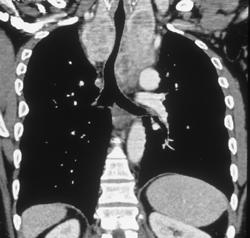 Substernal Thyroid - CTisus CT Scan