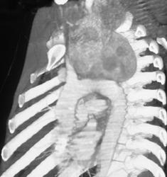 Substernal Thyroid in 3D - CTisus CT Scan