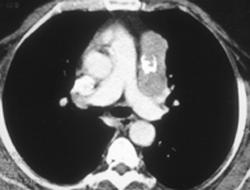 Calcified Inflammatory Nodes - CTisus CT Scan