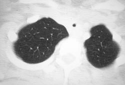 Tracheal Stenosis - CTisus CT Scan