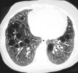 Lymphangioleiomyomatosis (lam) - CTisus CT Scan