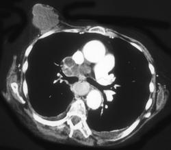 Breast Mass and Necrosis Mediastinal Nodes - CTisus CT Scan