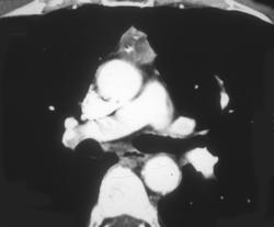 Thymoma - CTisus CT Scan