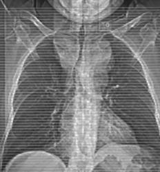 Substernal Thyroid - CTisus CT Scan