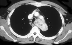 Substernal Thyroid - CTisus CT Scan