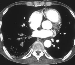 Pulmonary Embolism - CTisus CT Scan