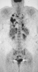 Lung Metastases - CTisus CT Scan