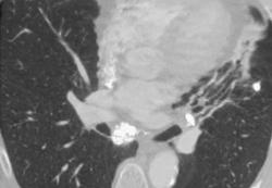 Broncholith With Secondary Bronchiectasis - CTisus CT Scan