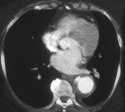 Ulcer in Thoracic Aneurysm - CTisus CT Scan