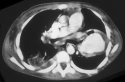 Pulmonary Artery Aneurysm - CTisus CT Scan