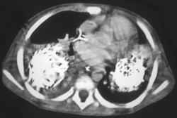 Ebbolized Pulmonary Artery Aneurysms - CTisus CT Scan