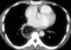 Achalasia - CTisus CT Scan