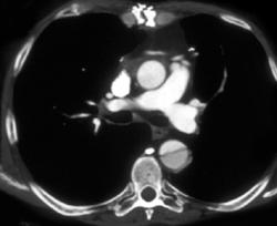 Thoracic Dissection - CTisus CT Scan