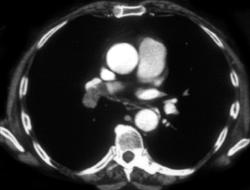 Pulmonary Embolism - CTisus CT Scan