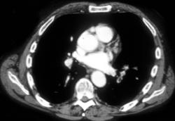 Pulmonary Embolism - CTisus CT Scan