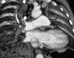 Pulmonary Embolism - CTisus CT Scan