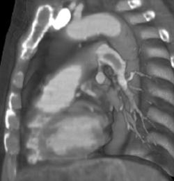 Pulmonary Embolism and Clot - CTisus CT Scan