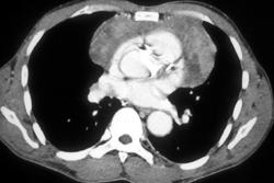 Lymphoma - CTisus CT Scan