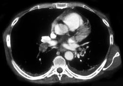 Pulmonary Embolism - CTisus CT Scan