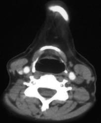 Pseudothrombosis in the Jugular Vein - CTisus CT Scan