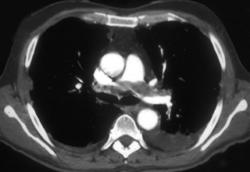 Pulmonary Embolism - CTisus CT Scan