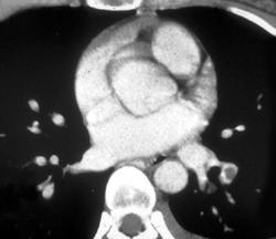 Pulmonary Embolism - CTisus CT Scan