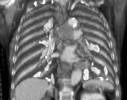 Pleural Plaques - CTisus CT Scan