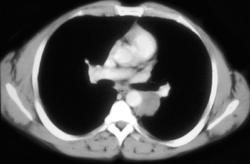 Bronchogenic Cyst - CTisus CT Scan