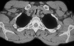 Thickened Trachea Due to Rhinoscleroma - CTisus CT Scan