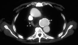 Ductus Aneurysm - CTisus CT Scan