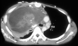 Teratoma Invades SVC - CTisus CT Scan