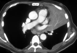 Collapsed Left Upper Lung - CTisus CT Scan