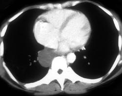 Bronchogenic Cyst - CTisus CT Scan