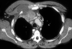 Germ Cell Tumor Invades the Chest Wall - CTisus CT Scan