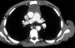 Thymoma - CTisus CT Scan