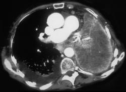 Lung Cancer With Malignant Pleural Effusion and Enhancing Pleura - CTisus CT Scan