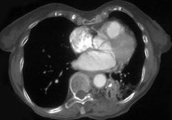 Foreign Body and Aspiration Pneumonia in Left Lower Lobe - CTisus CT Scan