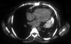 Retained Sponge in Pericardium - CTisus CT Scan