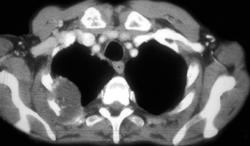 Renal Cancer in Horseshoe Kidney With Bone Metastases - CTisus CT Scan