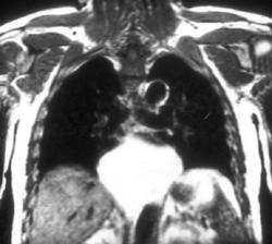 Mesenteric Fat Herniates Through Gastroesophageal (GE) Junction - CTisus CT Scan