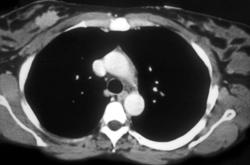 Right Breast Cancer and Carcinomatosis - CTisus CT Scan