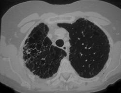 Interstitial Disease - CTisus CT Scan