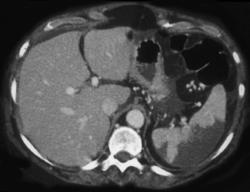 Pulmonary Emboli With Splenic Infarcts - CTisus CT Scan