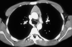 Prominent Normal Thymus in 18 Year Old - CTisus CT Scan