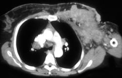 Breast Cancer With Nodes and Implants - CTisus CT Scan